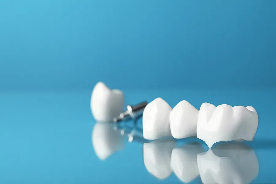 Benefits of Dental Crowns That Will Make You Smile — article cover