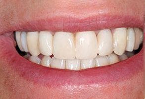 ToothDocs smile gallery case 1 — after treatment