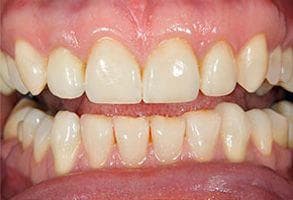 ToothDocs smile gallery case 2 — after treatment