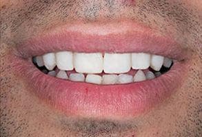 ToothDocs smile gallery case 3 — after treatment