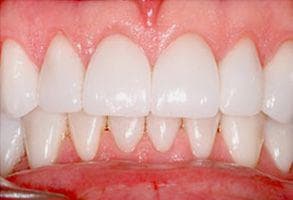 ToothDocs smile gallery case 4 — after treatment