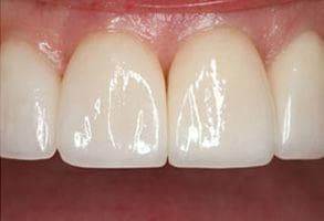 ToothDocs smile gallery case 5 — after treatment