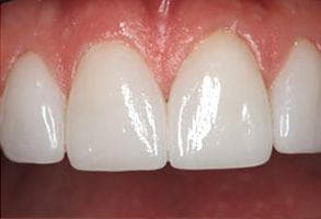 ToothDocs smile gallery case 6 — after treatment