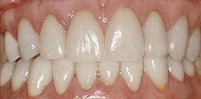 ToothDocs smile gallery case 7 — after treatment
