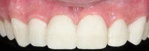 ToothDocs smile gallery case 8 — after treatment