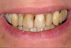 ToothDocs smile gallery case 1 — before treatment