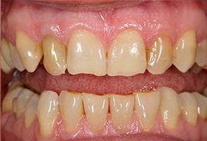 ToothDocs smile gallery case 2 — before treatment