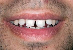 ToothDocs smile gallery case 3 — before treatment