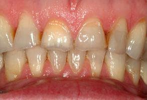 ToothDocs smile gallery case 4 — before treatment
