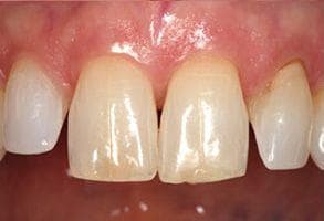 ToothDocs smile gallery case 5 — before treatment