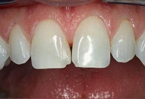 ToothDocs smile gallery case 6 — before treatment