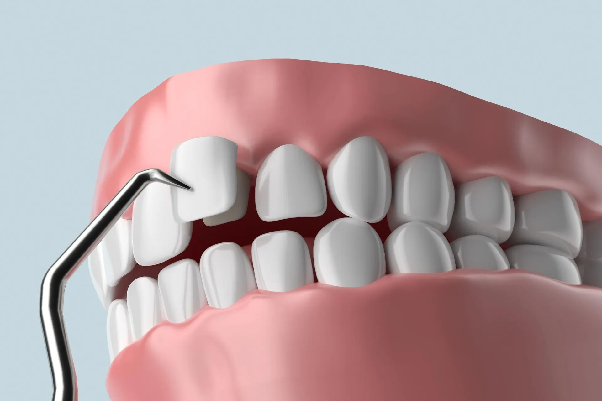 The Advantages of Dental Veneers — article cover