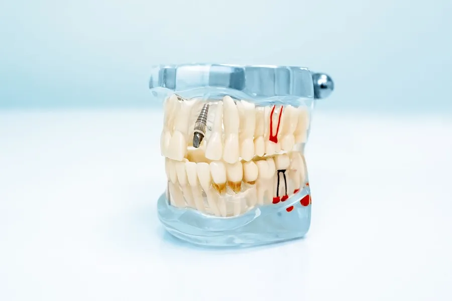 Dental Implants Are the Best Solution for Missing Teeth — article cover