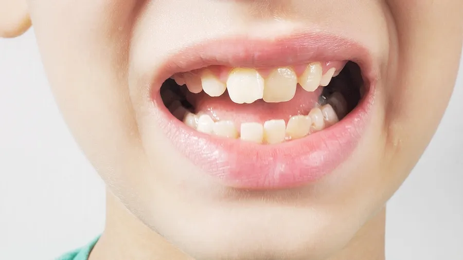How To Prevent Dental Emergencies? — article cover
