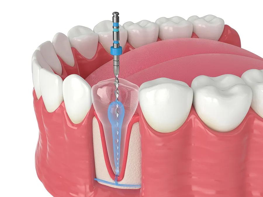 Understanding Endodontics: Saving Teeth with Advanced Care in New York and Roslyn, NY — article cover