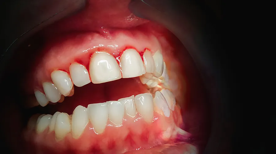 Comprehensive Care for Healthy Gums: Effective Gum Disease Treatments in New York and Roslyn, NY — article cover