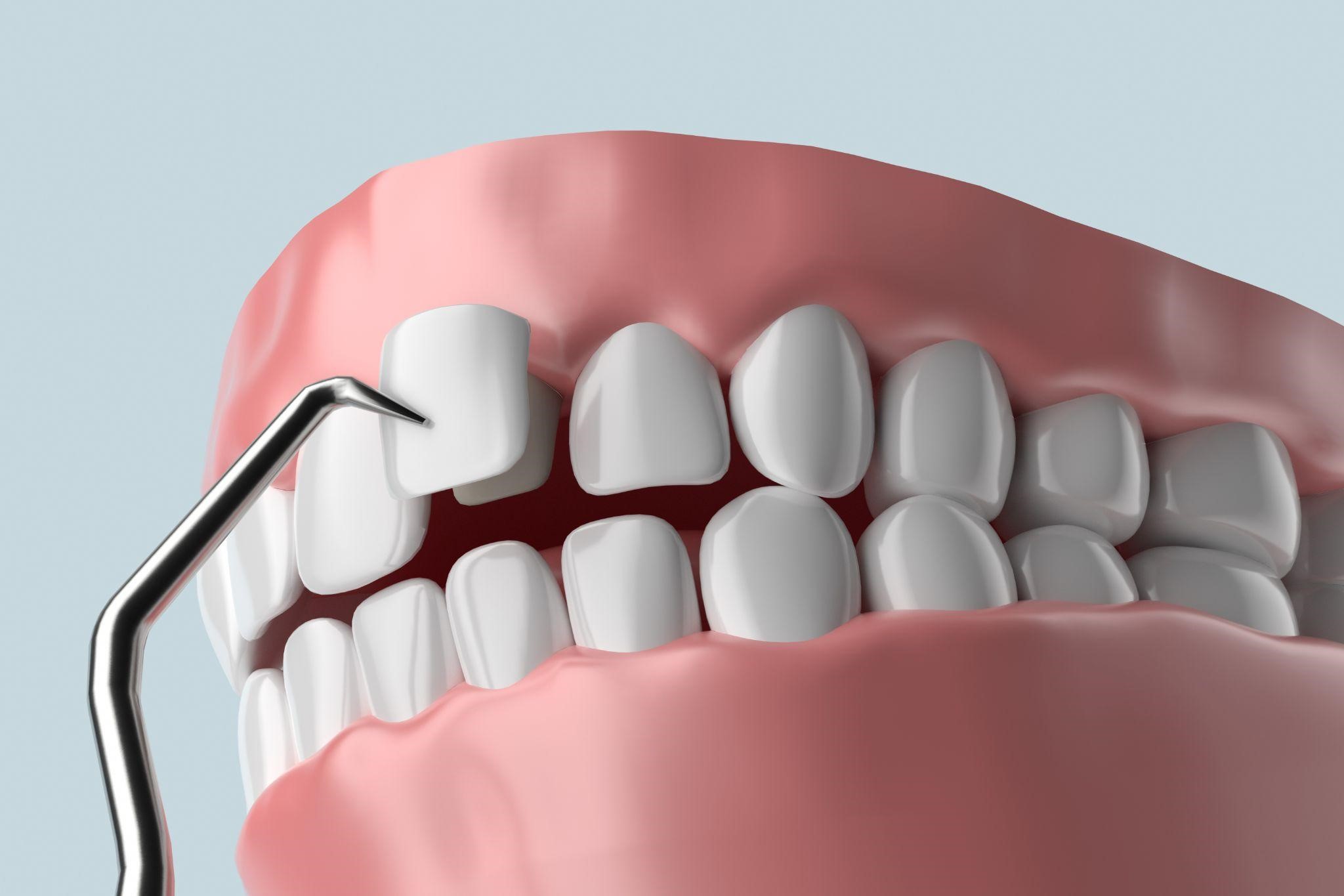 The Advantages of Dental Veneers