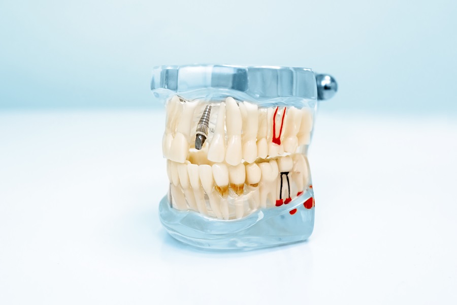 Dental Implants Are the Best Solution for Missing Teeth