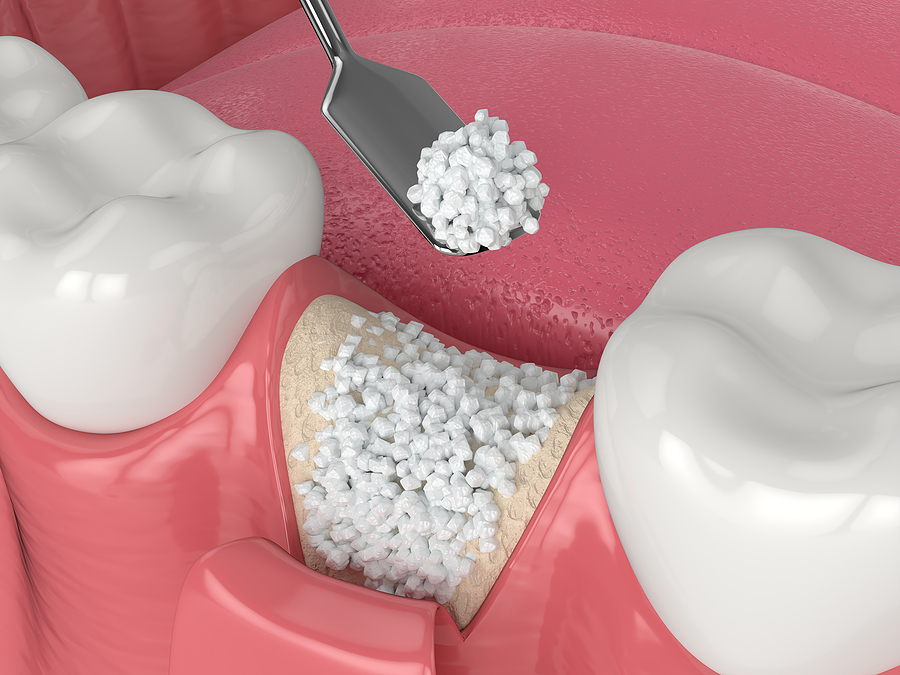 Bone Grafting in New York, NY: A Comprehensive Guide to Improving Dental Health